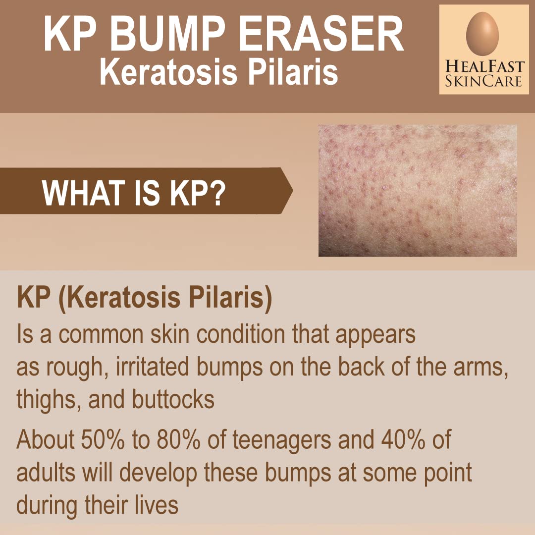 Healfast KP Bump Eraser Cream (4 Oz) and Bodywash (8 Oz) Set – Soften, Exfoliate, Nourish Rough and Bumpy Skin – Keratosis Pilaris - For All Types