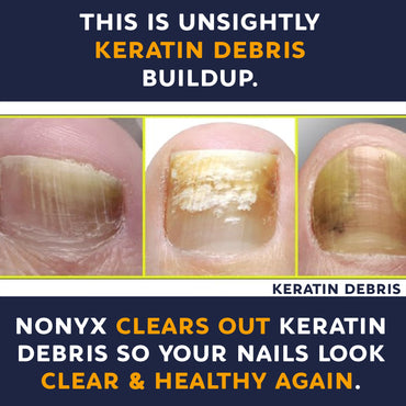 NONYX Nail Clarifying Gel | Clinically Proven for Discolored and Damaged Toenails | Restores the Appearance of Thick, Brittle, Yellow or Lifted Nails | Effective Nail Care Treatment | Made in the USA