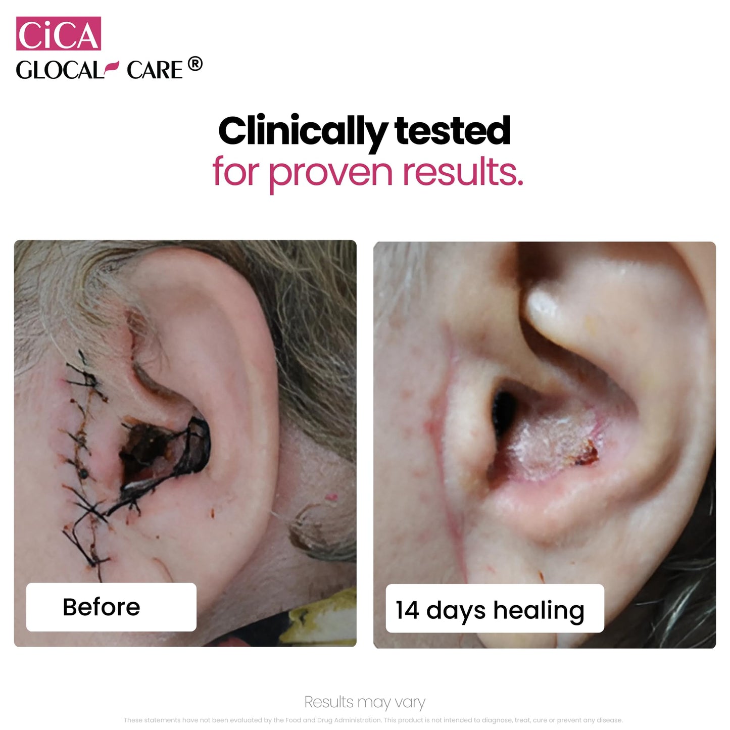 Cica GlocalCare – Clinically Proven Wound Healing Supplement
- Aids in Scar & Recovery Support - Helps with Skin & Tissue Repair for Surgery, Wounds, Scar Treatment & Bruising (30 Capsules)