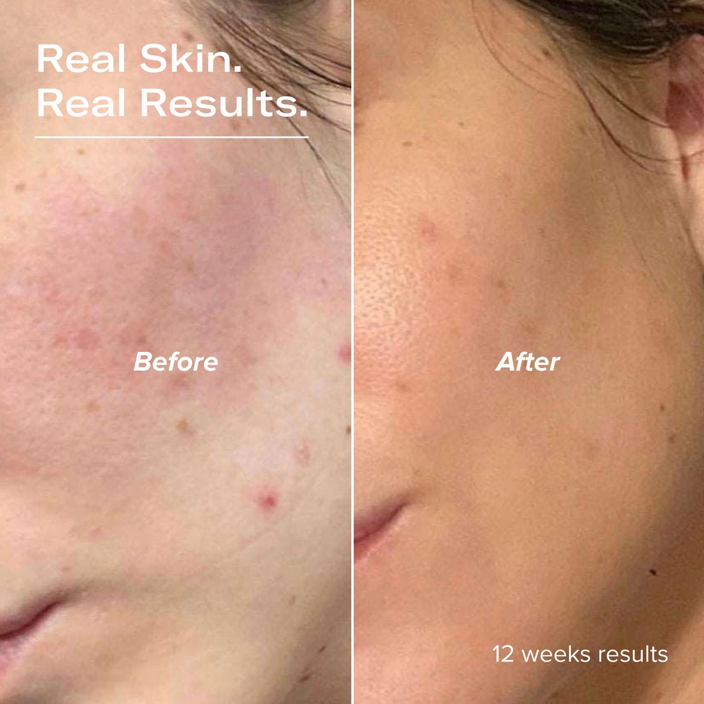 serum junkie PLUMP Hyaluronic Acid Serum with 5D Hyaluronic Complex, Ectoin, Plant Ceramides, Vitamins B5 & E, Deep Hydration, Strengthens Skin Barrier, Fragrance-Free, 1 fl oz