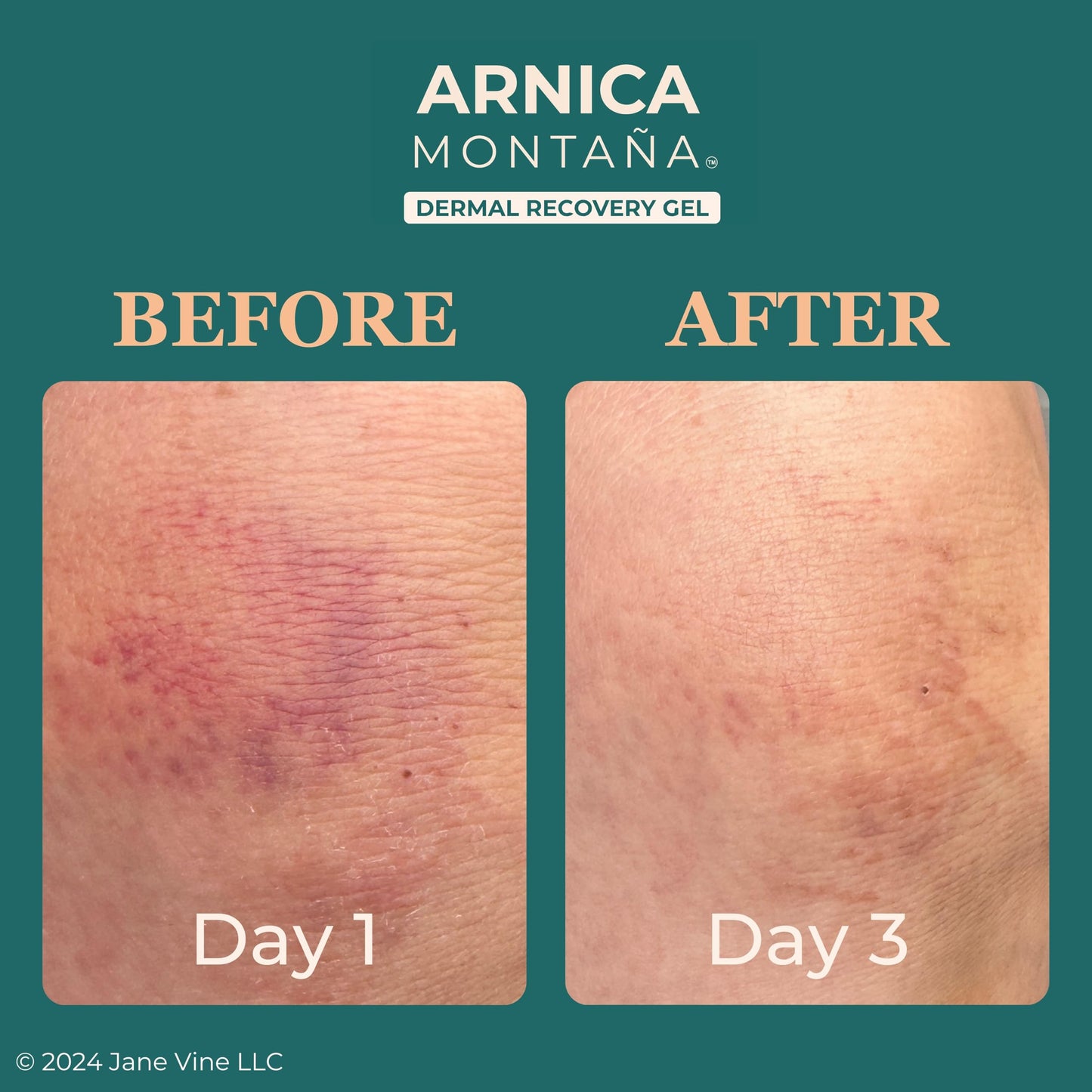 JANE VINE Arnica Gel For Face, Arnica Cream and Bruise Cream to Soothe with Aloe and Calendula for Face and Body, Menthol Free, Alcohol Free, 7oz Pump