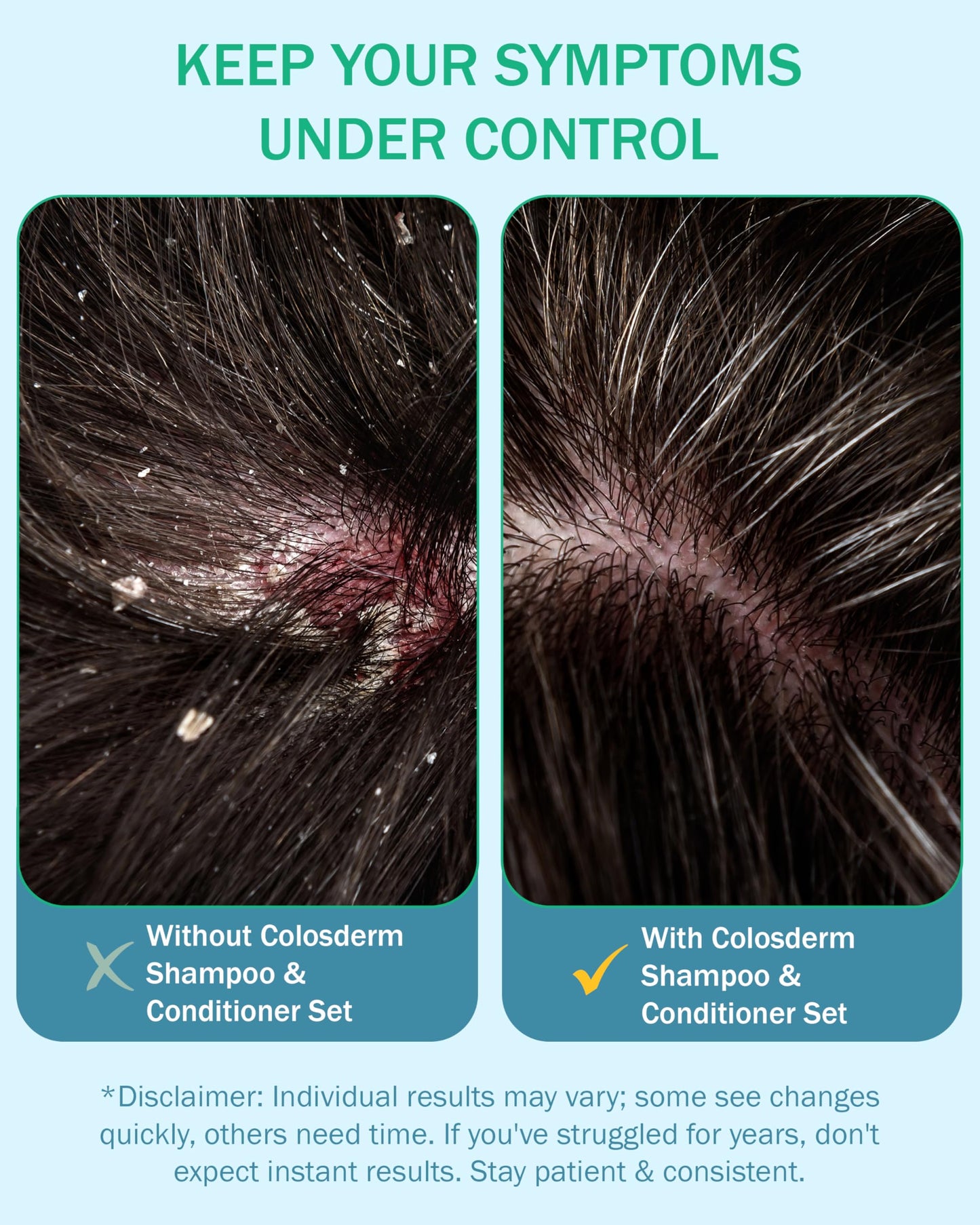 Eczema Cream Shampoo and Conditioner Scalp Treatment for Sensitive Skin for Kids & Adults- Colostrum & Colloidal Oatmeal -Itchy Scalp Anti Dandruff Shampoo for Women & Men, 16 fl oz, Made in USA