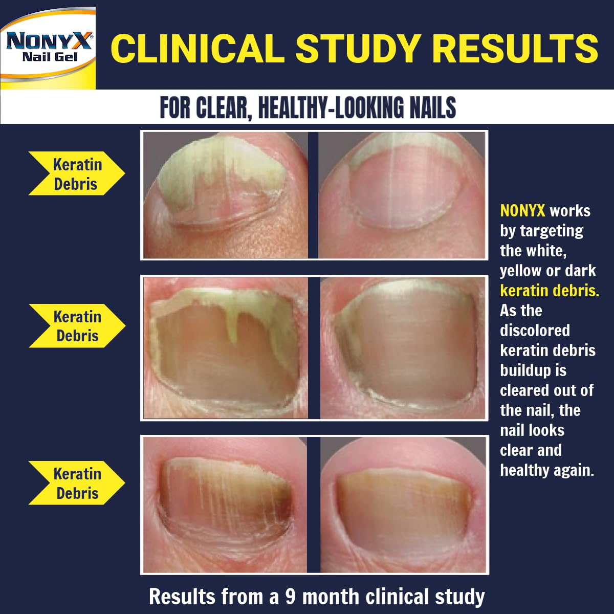 NONYX Nail Clarifying Gel | Clinically Proven for Discolored and Damaged Toenails | Restores the Appearance of Thick, Brittle, Yellow or Lifted Nails | Effective Nail Care Treatment | Made in the USA