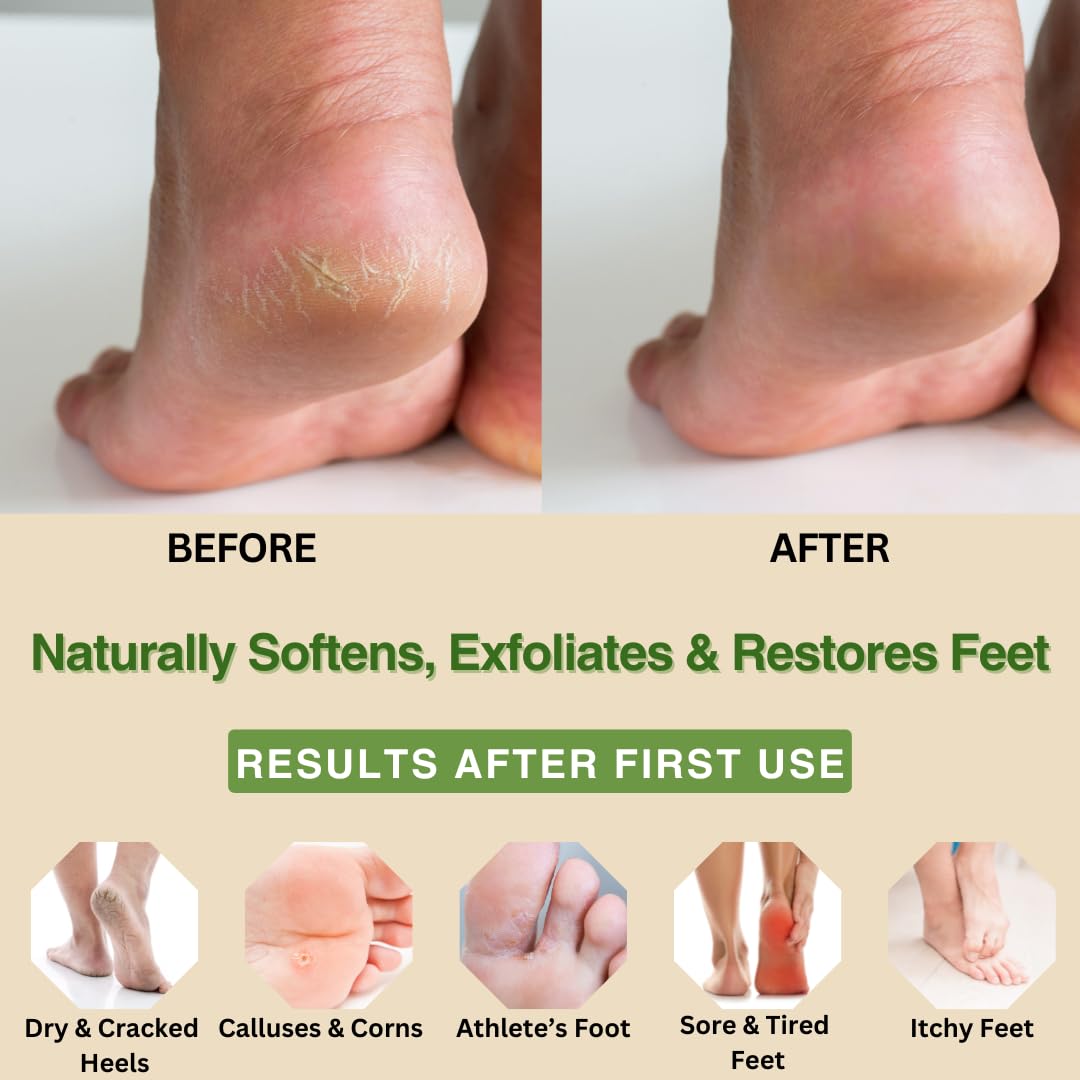 Natural Escapes Peppermint, Rosemary, Eucalyptus & Tea Tree Oil Foot Cream for Dry Feet, Cracked Heels, Calluses, Athlete's Foot - Heel Repair Cream for Women & Men (8 oz)