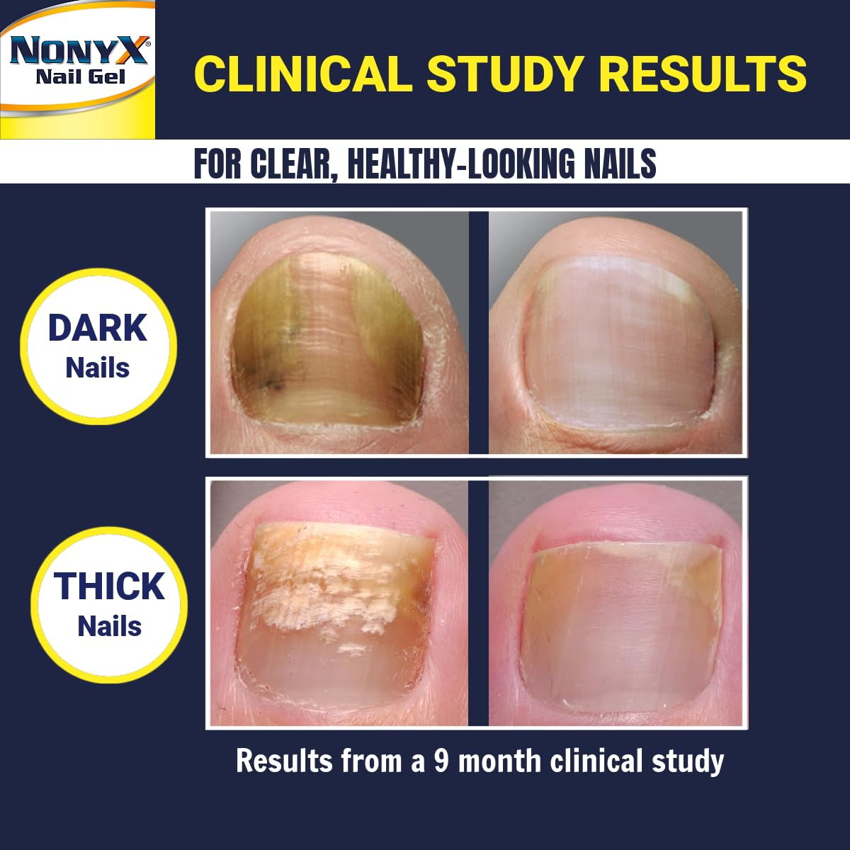 NONYX Nail Clarifying Gel | Clinically Proven for Discolored and Damaged Toenails | Restores the Appearance of Thick, Brittle, Yellow or Lifted Nails | Effective Nail Care Treatment | Made in the USA