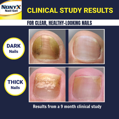 NONYX Nail Clarifying Gel | Clinically Proven for Discolored and Damaged Toenails | Restores the Appearance of Thick, Brittle, Yellow or Lifted Nails | Effective Nail Care Treatment | Made in the USA