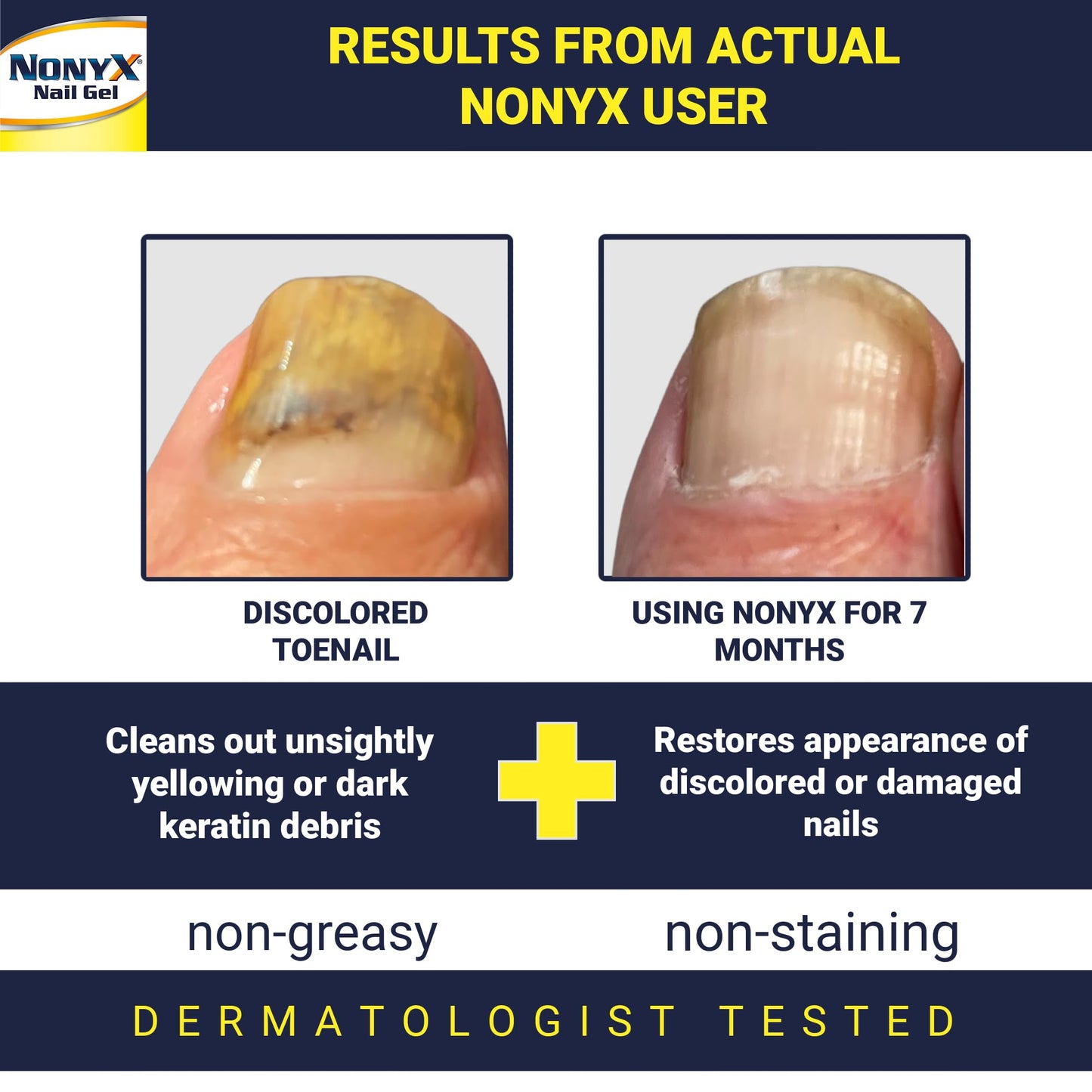 NONYX Nail Clarifying Gel | Clinically Proven for Discolored and Damaged Toenails | Restores the Appearance of Thick, Brittle, Yellow or Lifted Nails | Effective Nail Care Treatment | Made in the USA