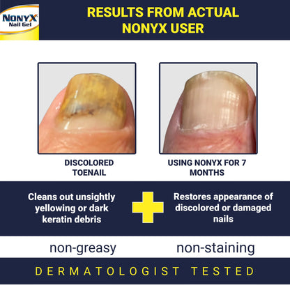 NONYX Nail Clarifying Gel | Clinically Proven for Discolored and Damaged Toenails | Restores the Appearance of Thick, Brittle, Yellow or Lifted Nails | Effective Nail Care Treatment | Made in the USA