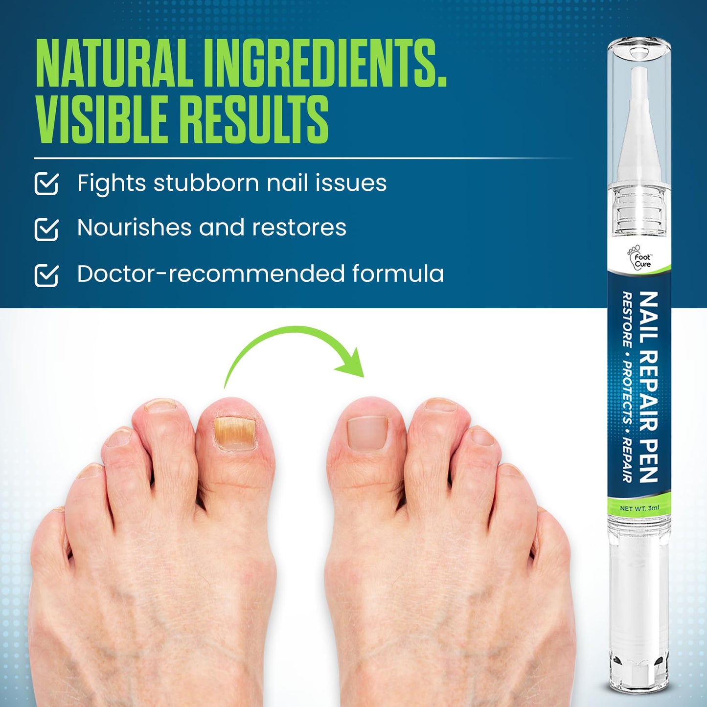 Footcure Toenail Fungus Treatment Extra Strength – 25% Undecylenic Acid Antifungal Pen, Repair & Restore Toenails & Fingernails, Natural Tea Tree & Oregano Oil, Made in USA (2-Pack)