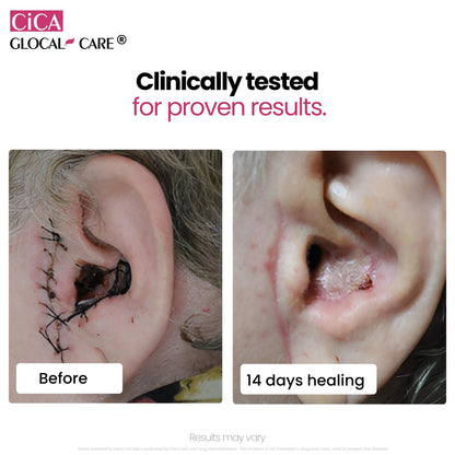 Cica GlocalCare – Clinically Proven Wound Healing Supplement - Aids in Scar & Recovery Support - Helps with Skin & Tissue Repair for Surgery, Wounds, Scar Treatment & Bruising (30 Capsules)