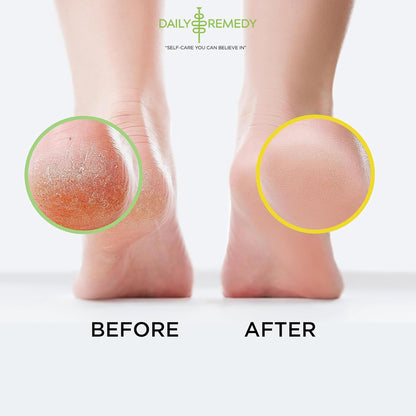 DAILY REMEDY Tea Tree Oil & Citrus Foot Soak Set, Pack of 2, for Foot Pain, Odor, Sore Feet, Athlete’s Foot, Soften Calluses - Natural Blend & Salts, Made In USA