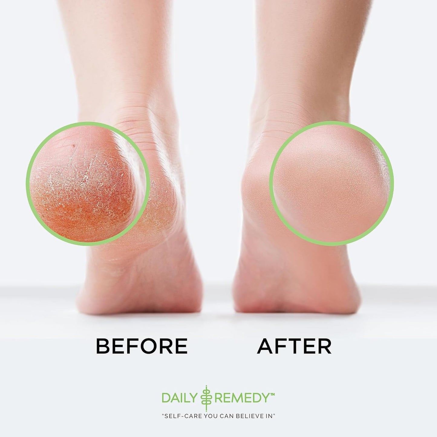 Foot Callus Remover Gel Set - Professional Callus Remover for Feet Gel - Calloused Feet Remover Gel - Feet Callus Remover for Smooth Feet & Cracked Heels - 8oz with Pumice Stone - Made in USA