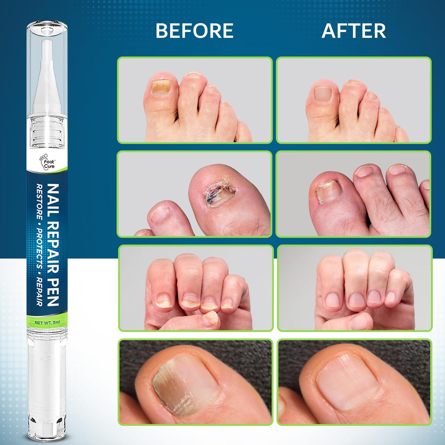 Footcure Toenail Fungus Treatment Extra Strength – 25% Undecylenic Acid Antifungal Pen, Repair & Restore Toenails & Fingernails, Natural Tea Tree & Oregano Oil, Made in USA (2-Pack)