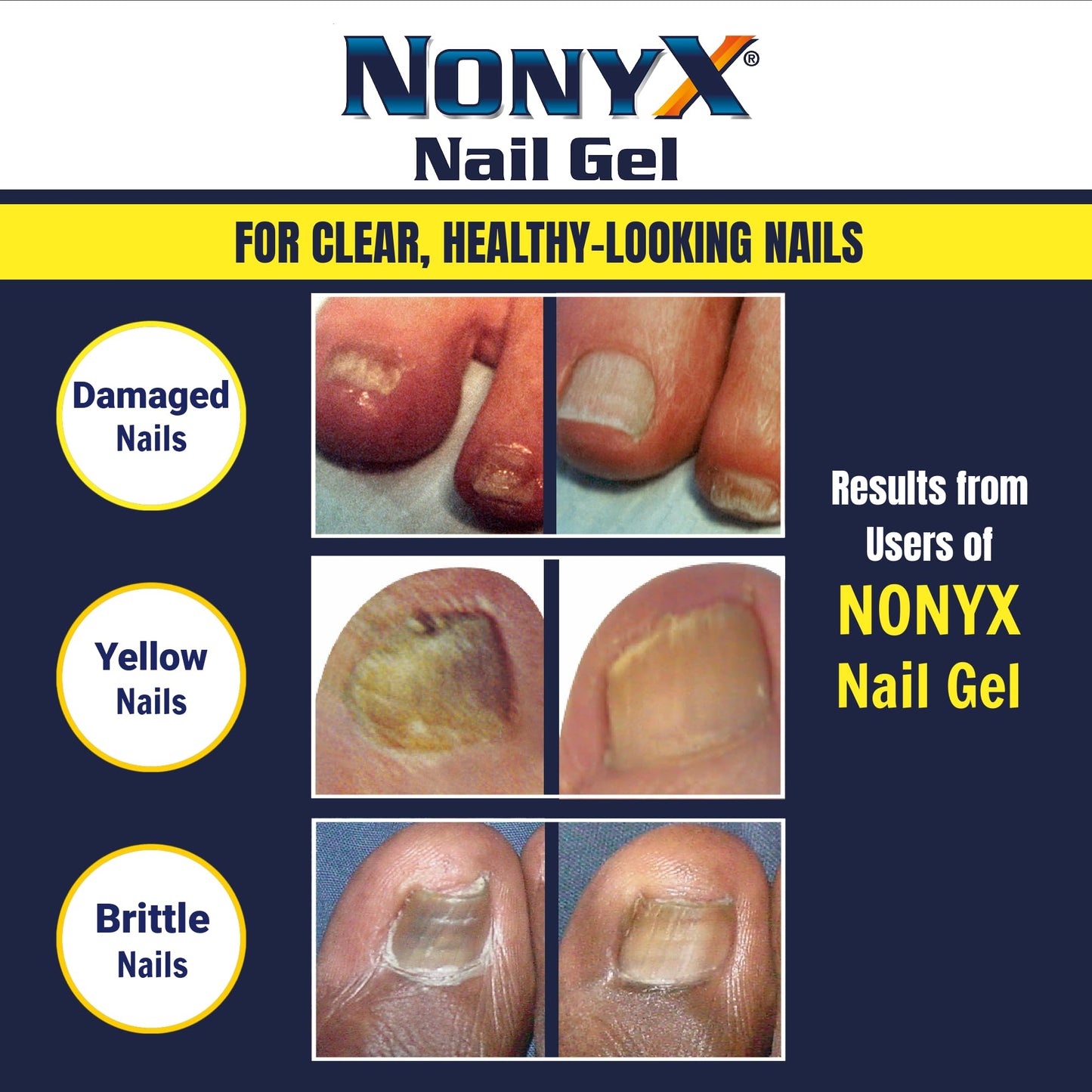 NONYX Nail Clarifying Gel | Clinically Proven for Discolored and Damaged Toenails | Restores the Appearance of Thick, Brittle, Yellow or Lifted Nails | Effective Nail Care Treatment | Made in the USA