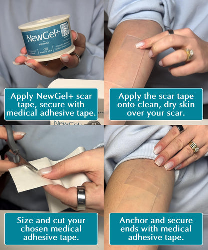 NewGel Plus Silicone Scar Tape Roll – 100% Medical-Grade Silicone Scar Sheets for Surgery, C-Section, Keloid & Acne Scars – Extra Thick 1mm Reusable Silicone Tape – Made in USA – 1.5” x 48”